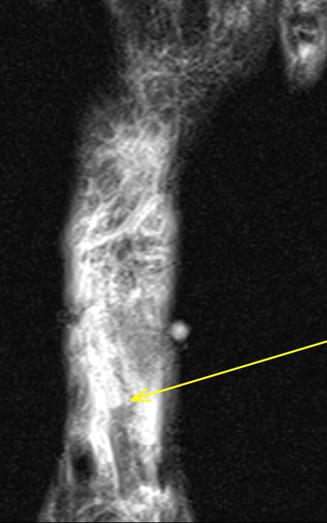Figure 3 for case Extensor hallucis longus tendon ( RID3188 ) laceration
